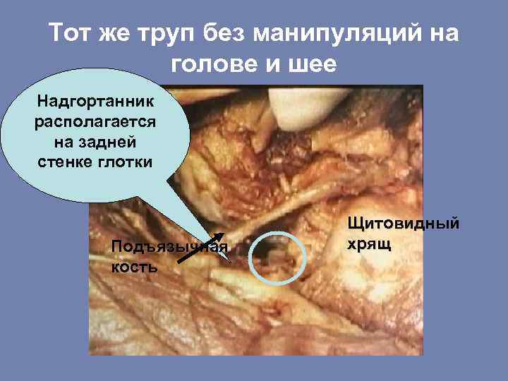Тот же труп без манипуляций на голове и шее Надгортанник располагается на задней стенке