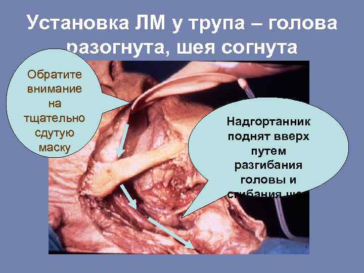 Установка ЛМ у трупа – голова разогнута, шея согнута Обратите внимание на тщательно сдутую