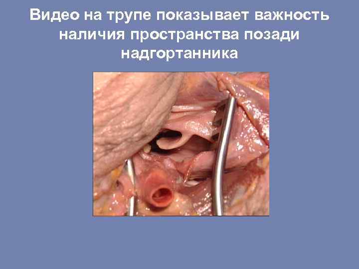 Видео на трупе показывает важность наличия пространства позади надгортанника 