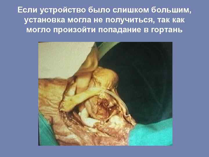 Если устройство было слишком большим, установка могла не получиться, так как могло произойти попадание
