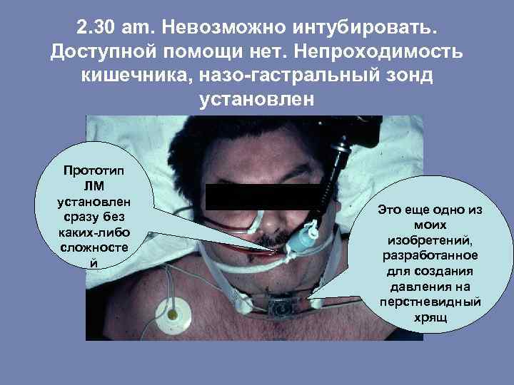 2. 30 am. Невозможно интубировать. Доступной помощи нет. Непроходимость кишечника, назо-гастральный зонд установлен Прототип