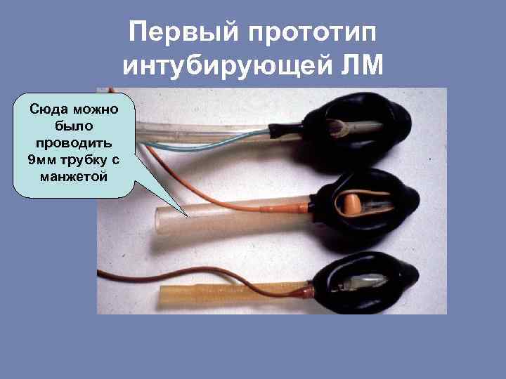 Первый прототип интубирующей ЛМ Сюда можно было проводить 9 мм трубку с манжетой 