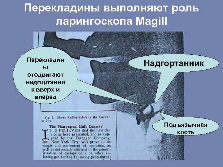 Перекладины выполняют роль ларингоскопа Magill Перекладин ы отодвигают надгортанни к вверх и вперед Надгортанник