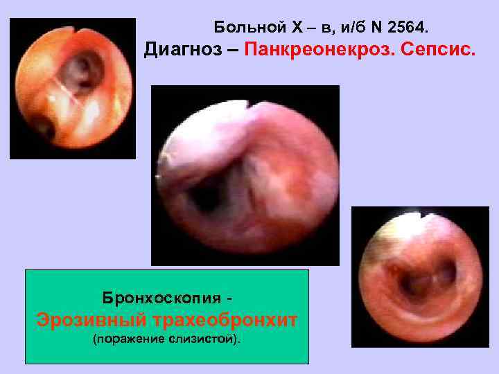 Больной Х – в, и/б N 2564. Диагноз – Панкреонекроз. Сепсис. Бронхоскопия - Эрозивный