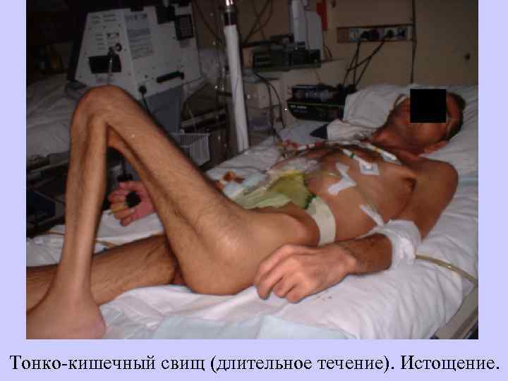 Тонко-кишечный свищ (длительное течение). Истощение. 