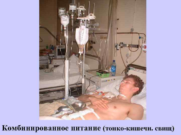 Комбинированное питание (тонко-кишечн. свищ) 