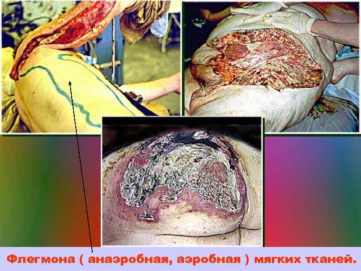 Флегмона ( анаэробная, аэробная ) мягких тканей. 