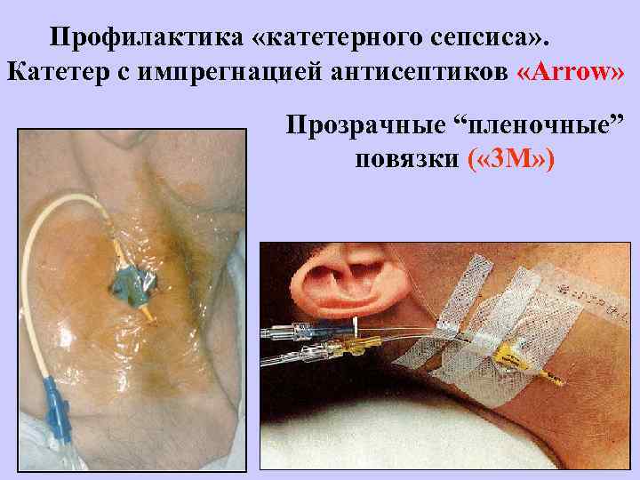 Профилактика «катетерного сепсиса» . Катетер с импрегнацией антисептиков «Arrow» Прозрачные “пленочные” повязки ( «
