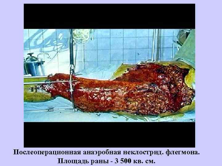 Послеоперационная анаэробная неклострид. флегмона. Площадь раны - 3 500 кв. см. 