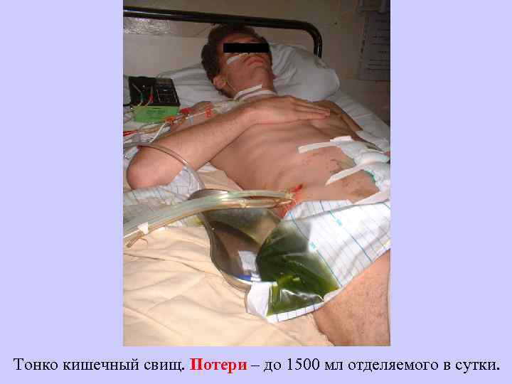 Тонко кишечный свищ. Потери – до 1500 мл отделяемого в сутки. 