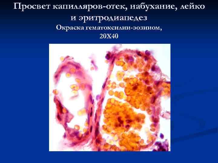 Просвет капилляров-отек, набухание, лейко и эритродиапедез Окраска гематоксилин-эозином, 20 Х 40 