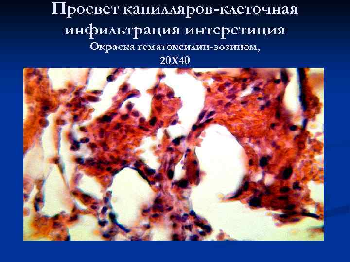 Просвет капилляров-клеточная инфильтрация интерстиция Окраска гематоксилин-эозином, 20 Х 40 