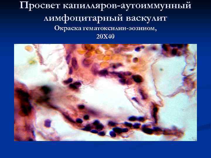 Просвет капилляров-аутоиммунный лимфоцитарный васкулит Окраска гематоксилин-эозином, 20 Х 40 