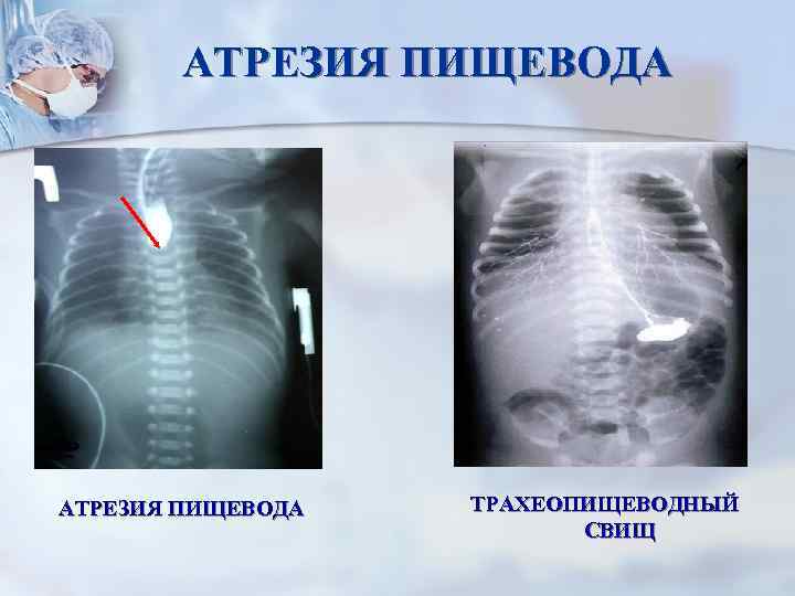 АТРЕЗИЯ ПИЩЕВОДА ТРАХЕОПИЩЕВОДНЫЙ СВИЩ 