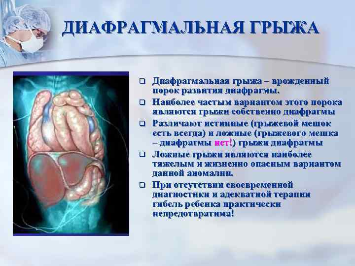 ДИАФРАГМАЛЬНАЯ ГРЫЖА q q q Диафрагмальная грыжа – врожденный порок развития диафрагмы. Наиболее частым