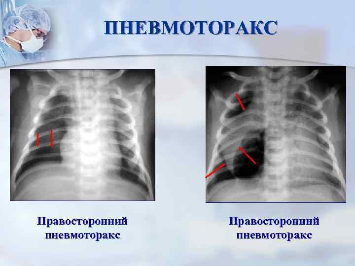 ПНЕВМОТОРАКС Правосторонний пневмоторакс 