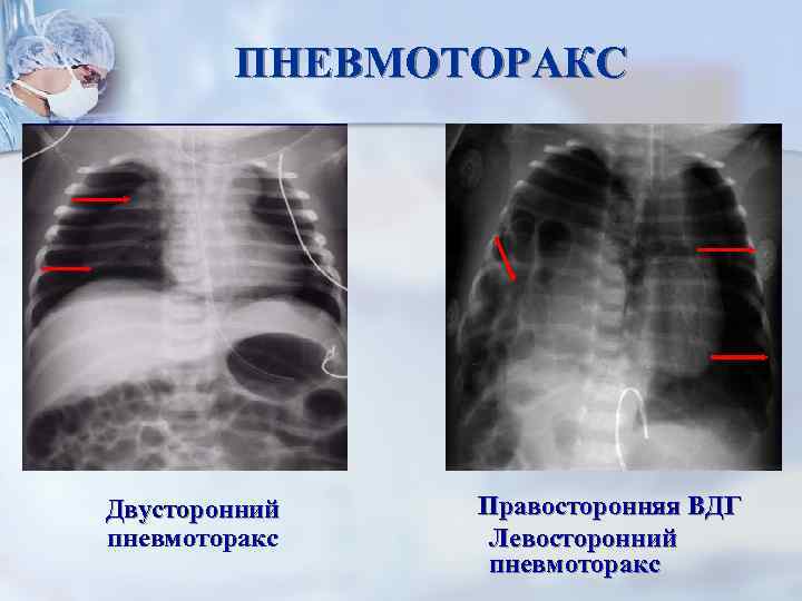 ПНЕВМОТОРАКС Двусторонний пневмоторакс Правосторонняя ВДГ Левосторонний пневмоторакс 