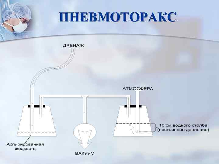 ПНЕВМОТОРАКС 