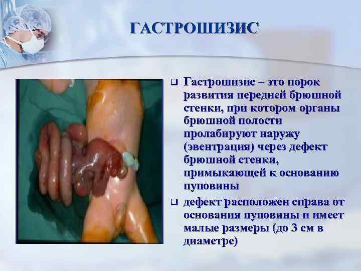 ГАСТРОШИЗИС q q Гастрошизис – это порок развития передней брюшной стенки, при котором органы