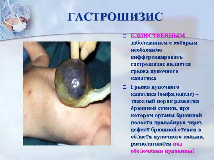 ГАСТРОШИЗИС q q ЕДИНСТВЕННЫМ заболеванием с которым необходимо дифференцировать гастрошизис является грыжа пупочного канатика