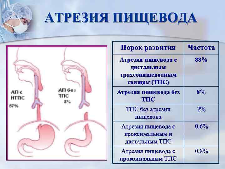 АТРЕЗИЯ ПИЩЕВОДА Порок развития Частота Атрезия пищевода с дистальным трахеопищеводным свищом (ТПС) 88% Атрезия