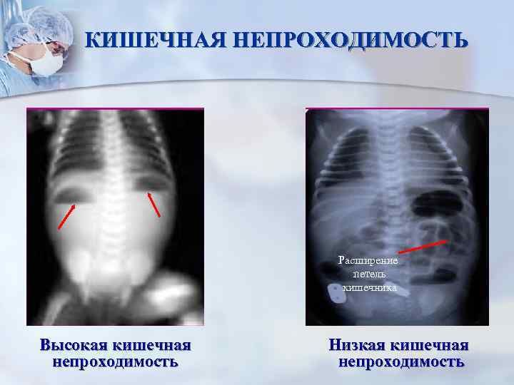 КИШЕЧНАЯ НЕПРОХОДИМОСТЬ Расширение петель кишечника Высокая кишечная непроходимость Низкая кишечная непроходимость 