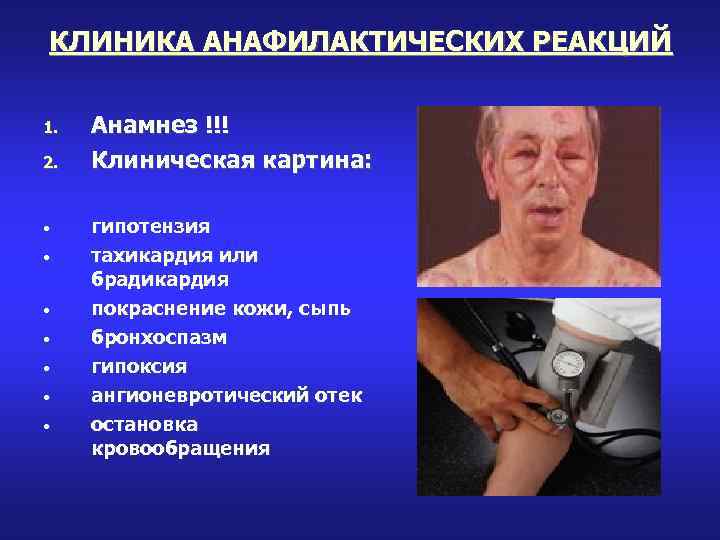 КЛИНИКА АНАФИЛАКТИЧЕСКИХ РЕАКЦИЙ 1. 2. • • Анамнез !!! Клиническая картина: гипотензия тахикардия или