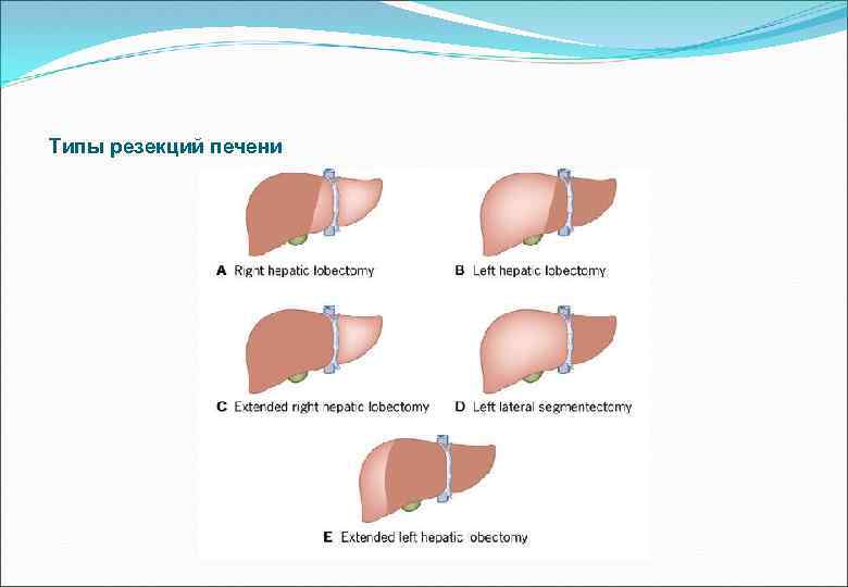 Типы резекций печени 