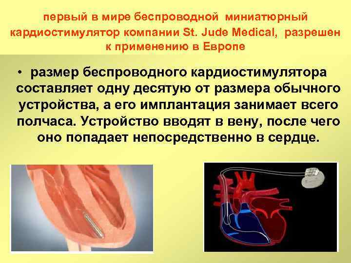 Установка кардиостимулятора плюсы и минусы