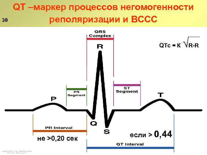 30 QT –маркер процессов негомогенности реполяризации и ВССС QTс = К не ˃0, 20