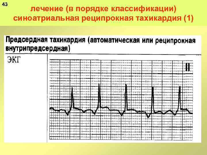 43 лечение (в порядке классификации) синоатриальная реципрокная тахикардия (1) 