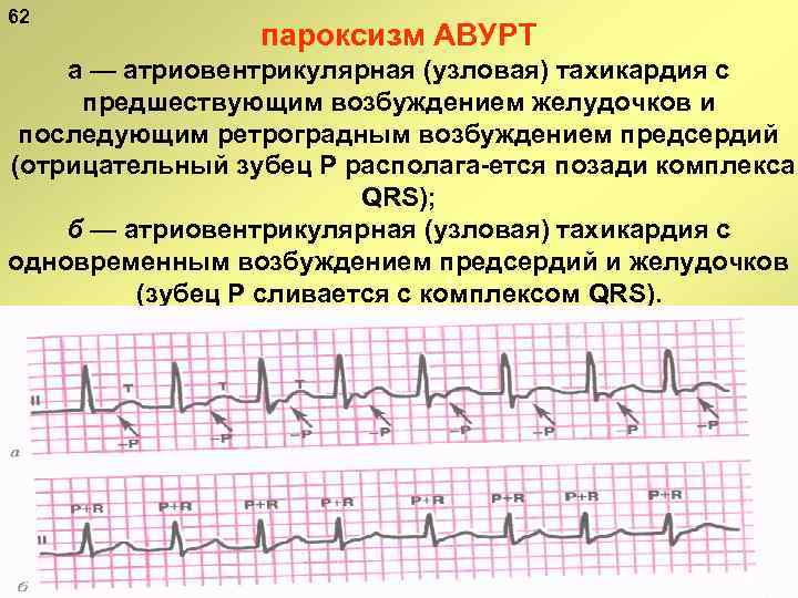 62 пароксизм АВУРТ а — атриовентрикулярная (узловая) тахикардия с предшествующим возбуждением желудочков и последующим