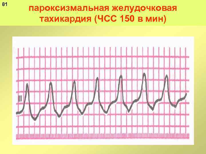 81 пароксизмальная желудочковая тахикардия (ЧСС 150 в мин) 