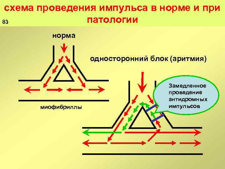 схема проведения импульса в норме и при патологии 83 норма односторонний блок (аритмия) миофибриллы