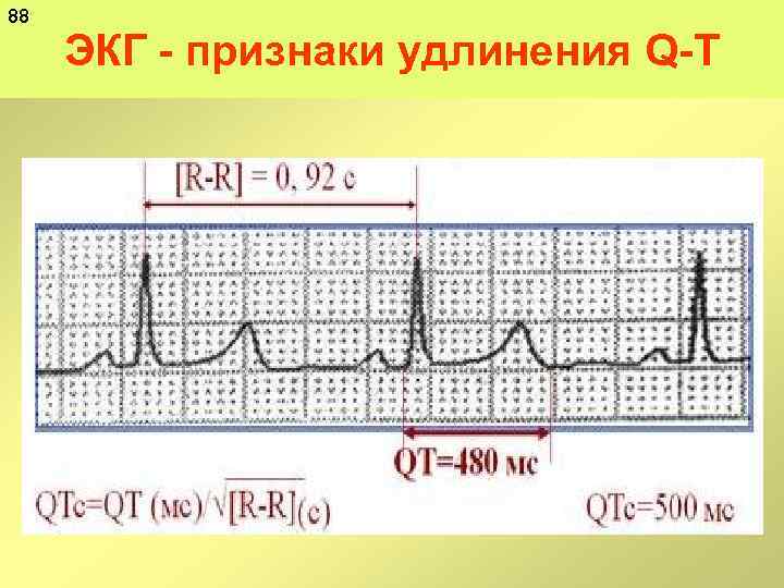 88 ЭКГ признаки удлинения Q T 