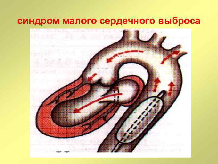 Мало сердечный. Синдром малого сердечного выброса. Синдром «малого сердечного выброса» наблюдается:. Низкий сердечный выброс. Синдром малого сердечного выброса у детей.