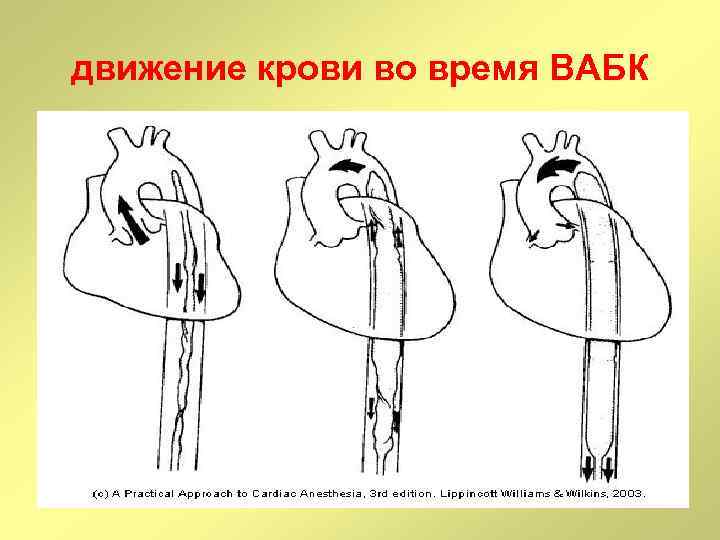 движение крови во время ВАБК 