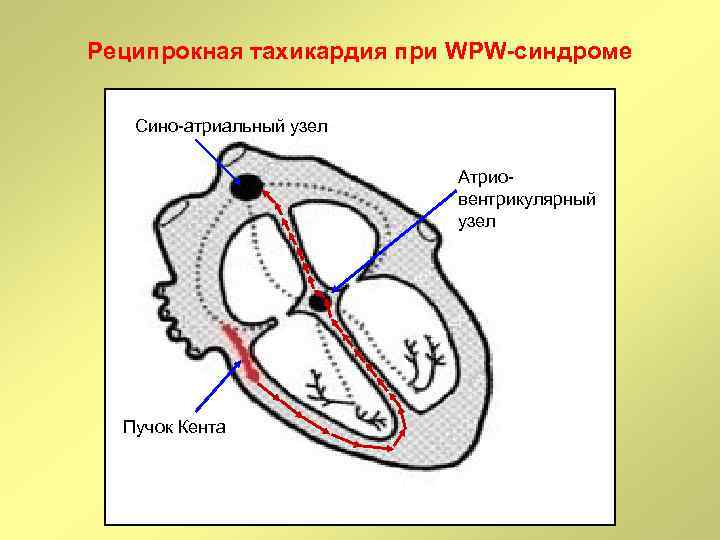 Реципрокная тахикардия при WPW-синдроме Сино-атриальный узел Атриовентрикулярный узел Пучок Кента 