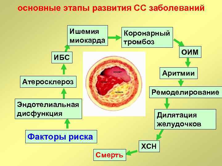 основные этапы развития СС заболеваний Ишемия миокарда Коронарный тромбоз ОИМ ИБС Аритмии Атеросклероз Ремоделирование