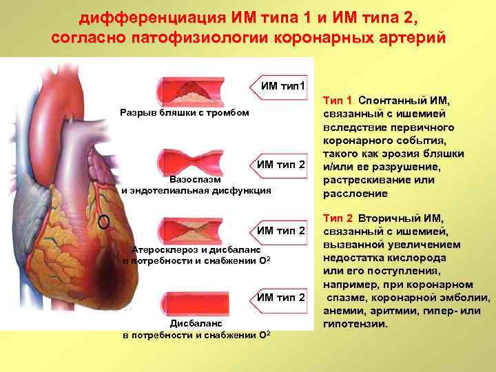 дифференциация ИМ типа 1 и ИМ типа 2, согласно патофизиологии коронарных артерий ИМ тип