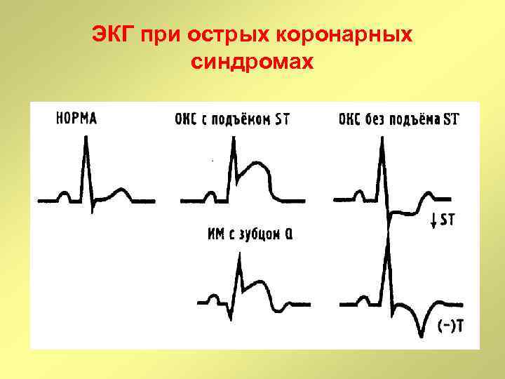 ЭКГ при острых коронарных синдромах 