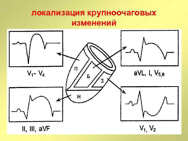 локализация крупноочаговых изменений 