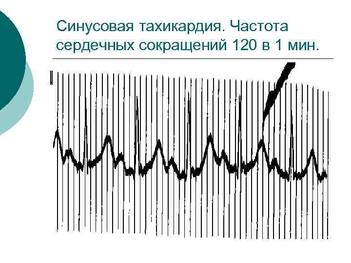 Синусовая тахикардия. Частота сердечных сокращений 120 в 1 мин. 