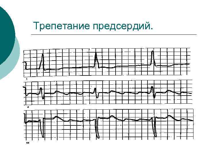 Трепетание предсердий. 