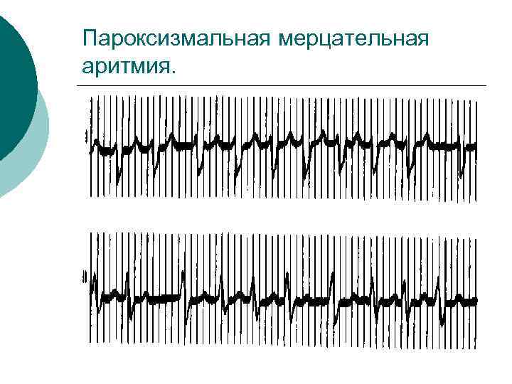 Пароксизмальная мерцательная аритмия. 
