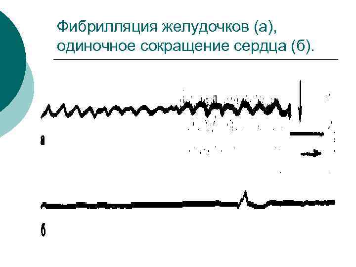 Фибрилляция желудочков (а), одиночное сокращение сердца (б). 