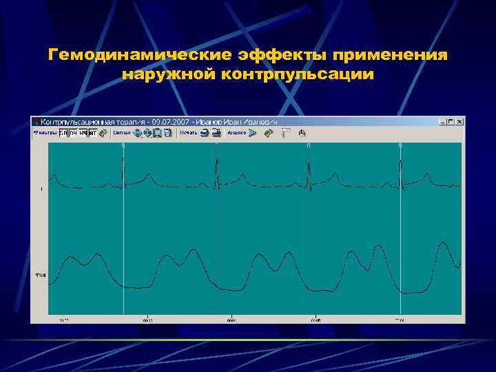 Гемодинамические эффекты применения наружной контрпульсации 