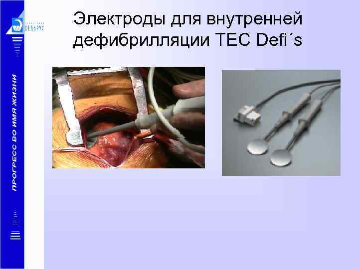 Электроды для внутренней дефибрилляции TEC Defi´s 