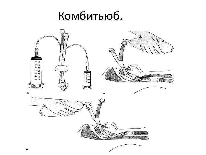 Комбитьюб. 