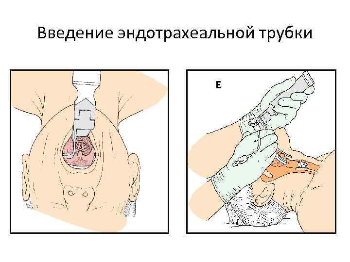 Введение эндотрахеальной трубки 